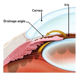 Angle Closure Glaucoma Detection and Interventions Glaucoma